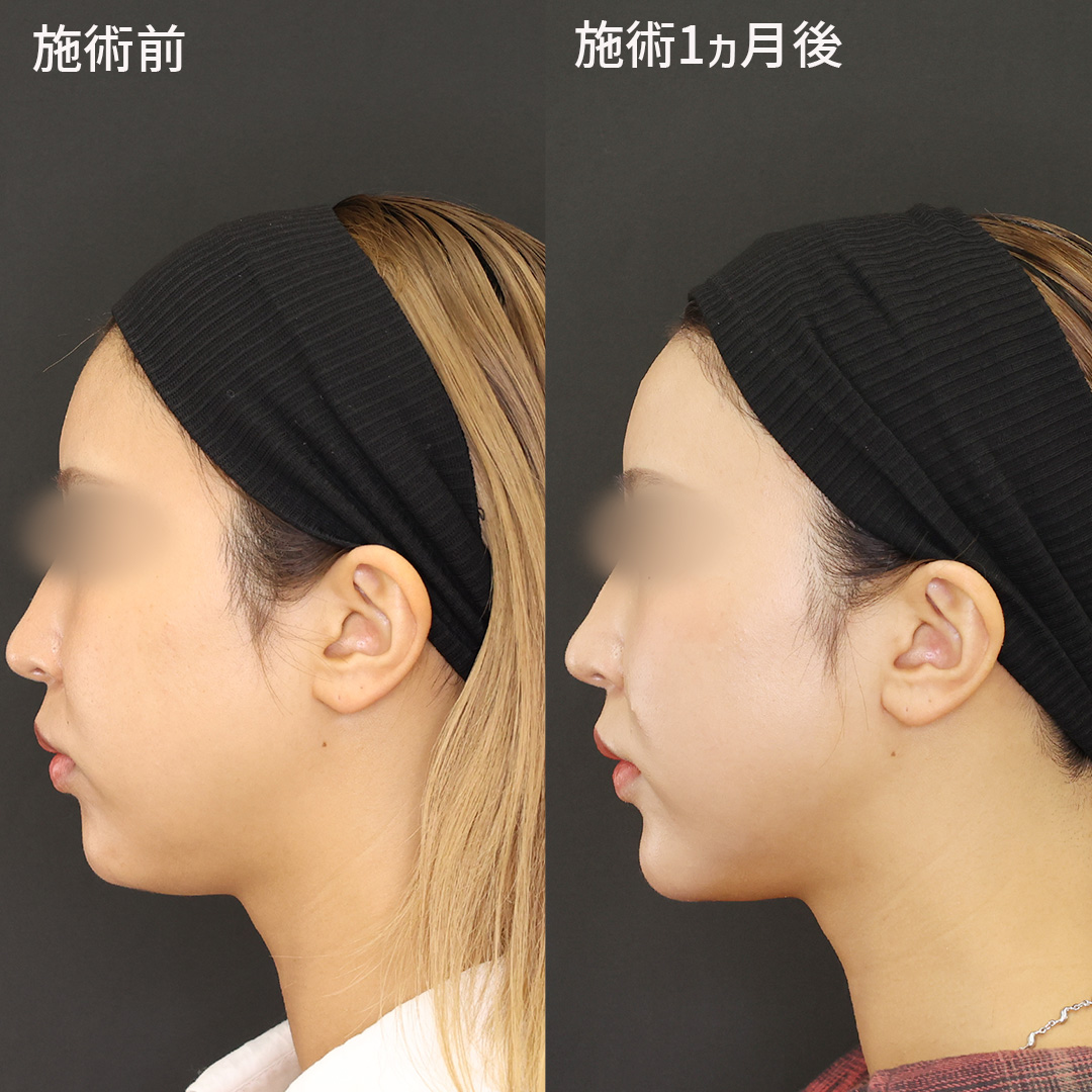 TAC式 ツヤ肌コラーゲンリフト®/ナゾラビアルファット除去/顎のヒアルロン酸注射の症例写真 施術前後 