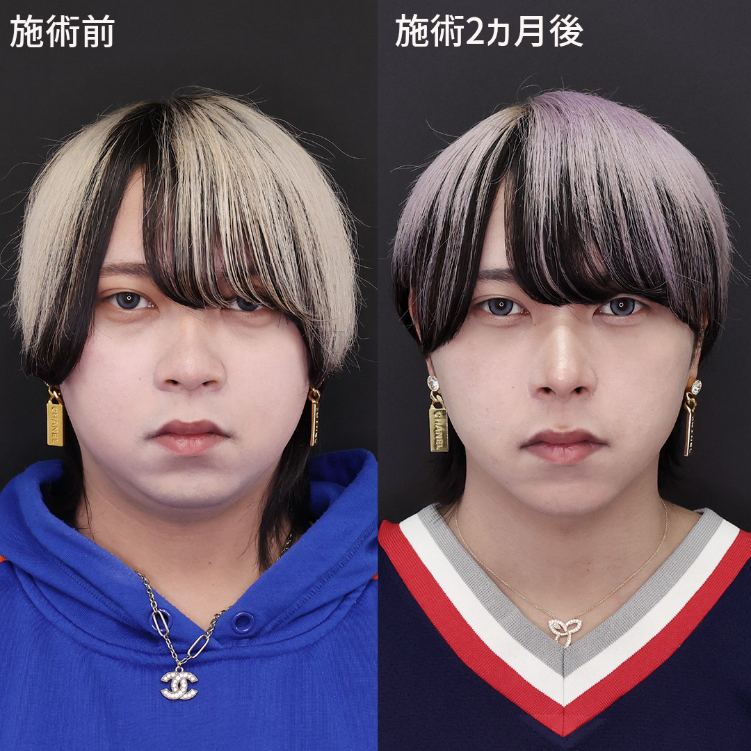 鼻整形 男性 症例写真 (正面)
