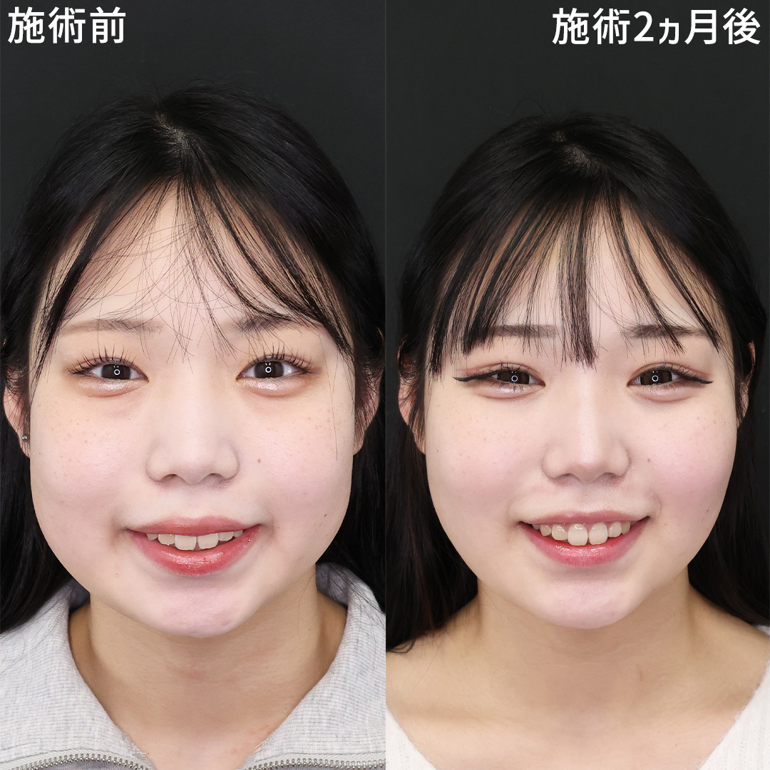 【クマ取り×小顔】痩せてもなくならない顔のお肉を撃退！