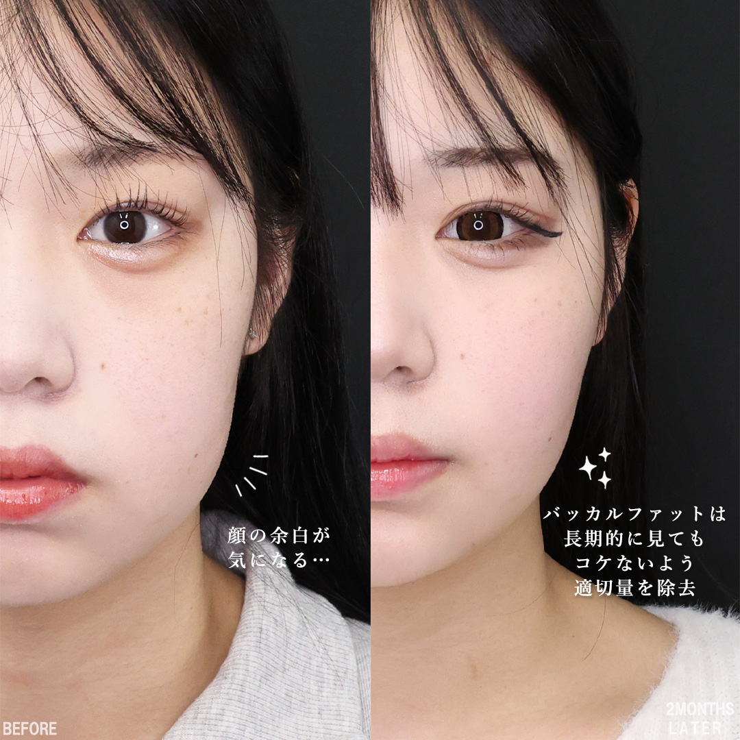 TAC式 ツヤ肌コラーゲンリフト®/バッカルファット除去/下眼瞼脱脂術（目の下のたるみ取り・目の下の脂肪ふくらみ取り）の症例写真 施術前後 