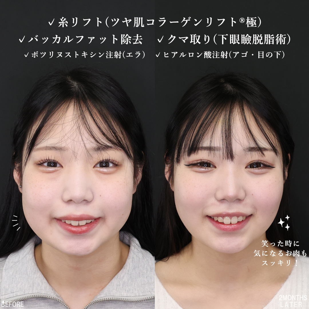 TAC式 ツヤ肌コラーゲンリフト®/バッカルファット除去/下眼瞼脱脂術（目の下のたるみ取り・目の下の脂肪ふくらみ取り）の症例写真 施術前後 