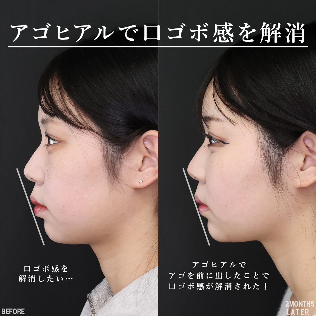 TAC式 ツヤ肌コラーゲンリフト®/バッカルファット除去/下眼瞼脱脂術（目の下のたるみ取り・目の下の脂肪ふくらみ取り）の症例写真 施術前後 