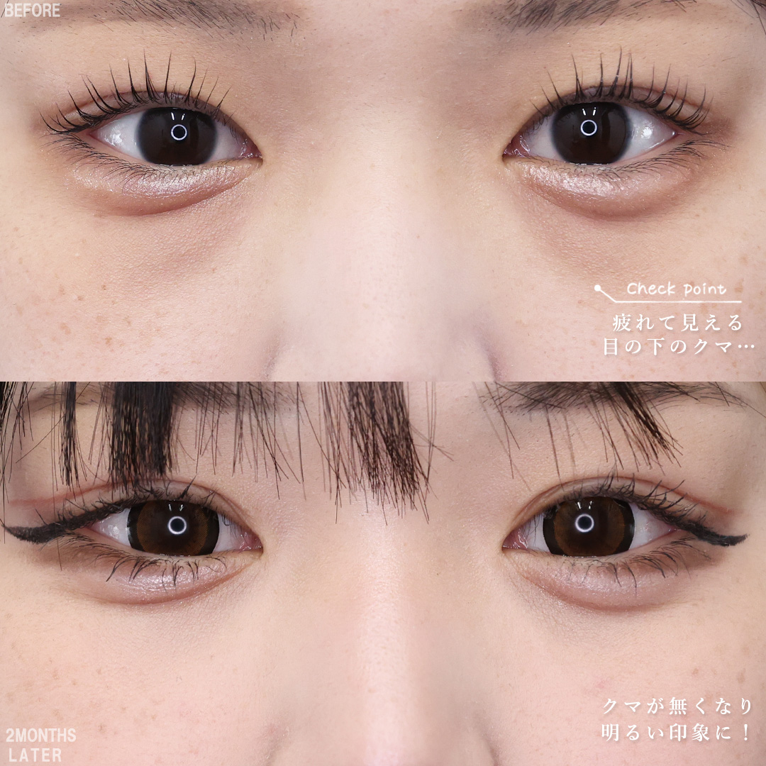 TAC式 ツヤ肌コラーゲンリフト®/バッカルファット除去/下眼瞼脱脂術（目の下のたるみ取り・目の下の脂肪ふくらみ取り）の症例写真 施術前後 
