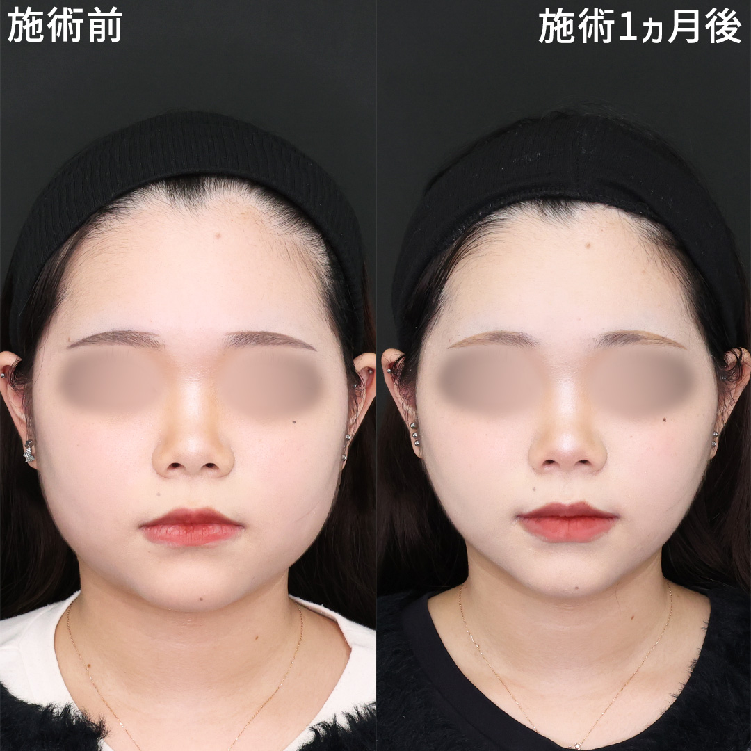 下膨れ顔が脂肪除去と糸リフトでカワイイ卵型の輪郭へ