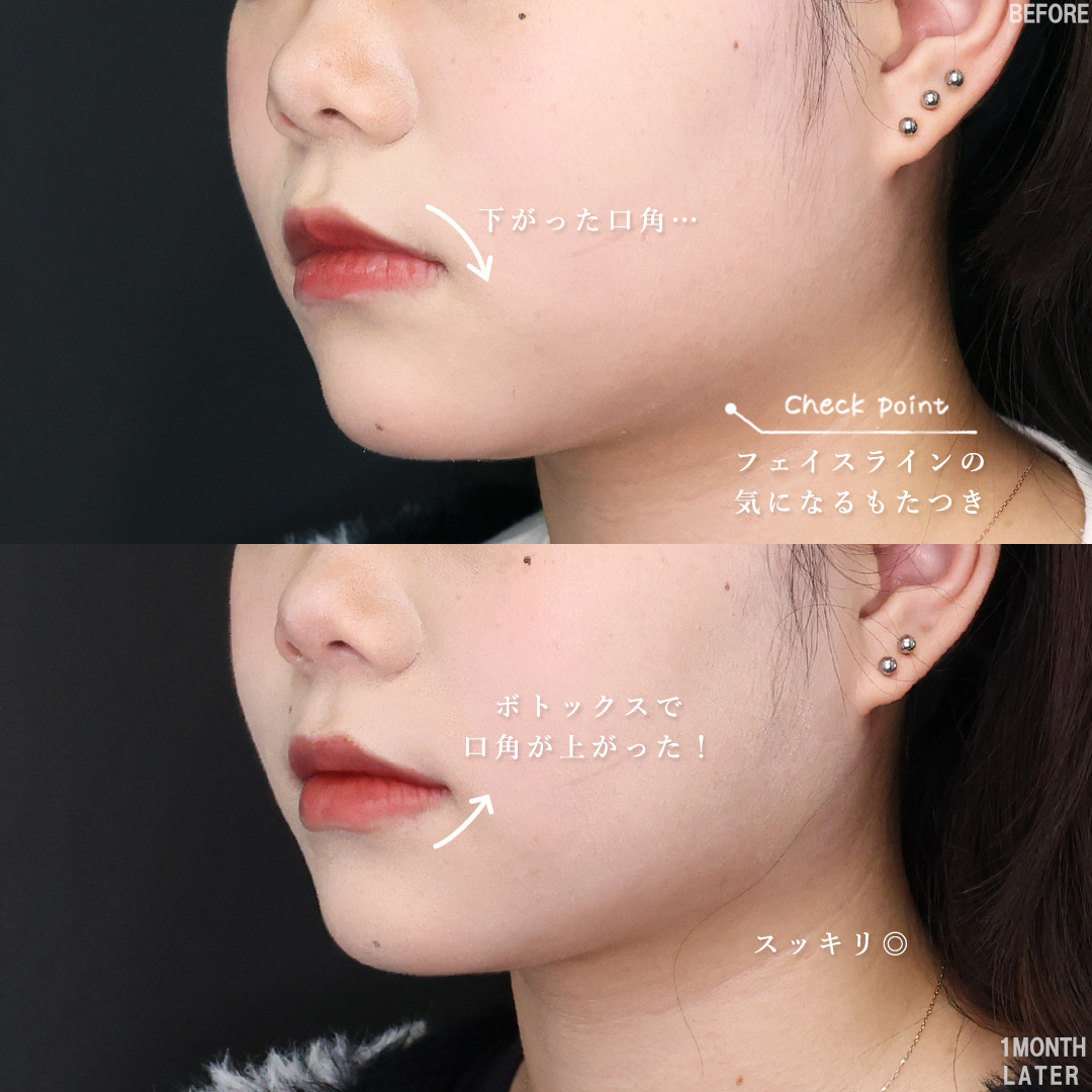 TAC式 ツヤ肌コラーゲンリフト®/Lラインファット除去（エラ下脂肪除去）/エラボトックス注射の症例写真 施術前後 