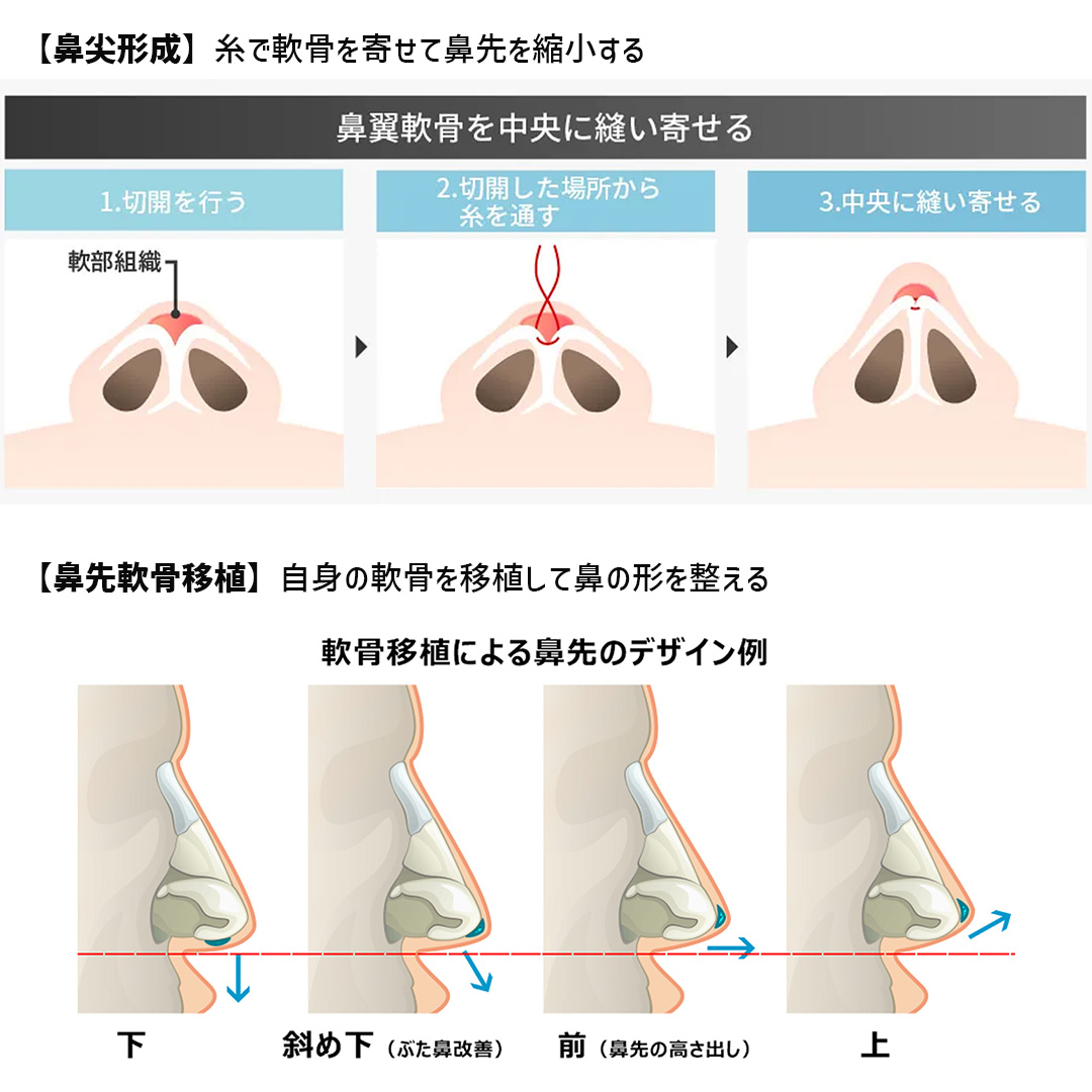 鼻尖形成・鼻尖縮小/バッカルファット除去/ジョールファット除去の症例写真 施術前後