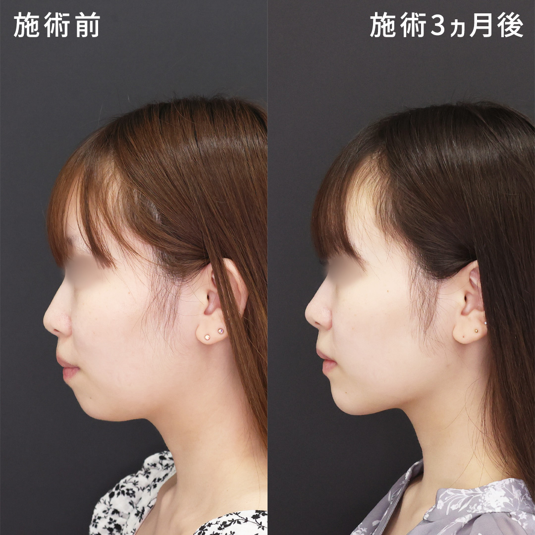 本来の美しさを引き出す小顔術