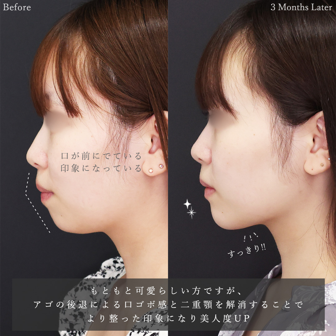 TAC式 ツヤ肌コラーゲンリフト®/Lラインファット除去(エラ下脂肪除去)/顔の脂肪吸引の症例写真 施術前後