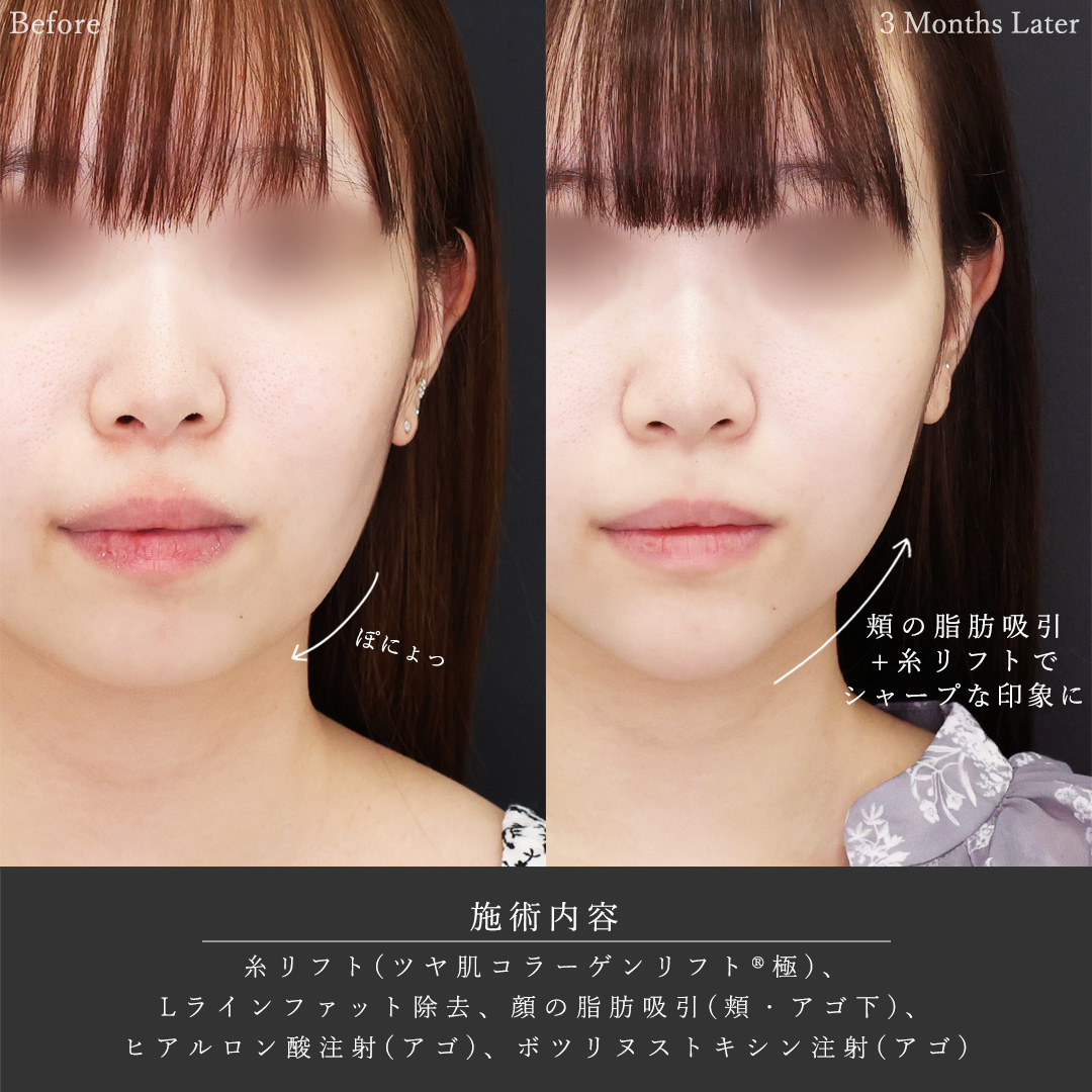TAC式 ツヤ肌コラーゲンリフト®/Lラインファット除去(エラ下脂肪除去)/顔の脂肪吸引の症例写真 施術前後