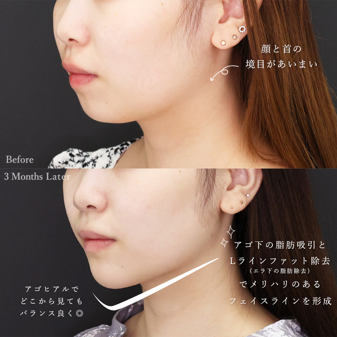 TAC式 ツヤ肌コラーゲンリフト®/Lラインファット除去(エラ下脂肪除去)/顔の脂肪吸引の症例写真 施術前後