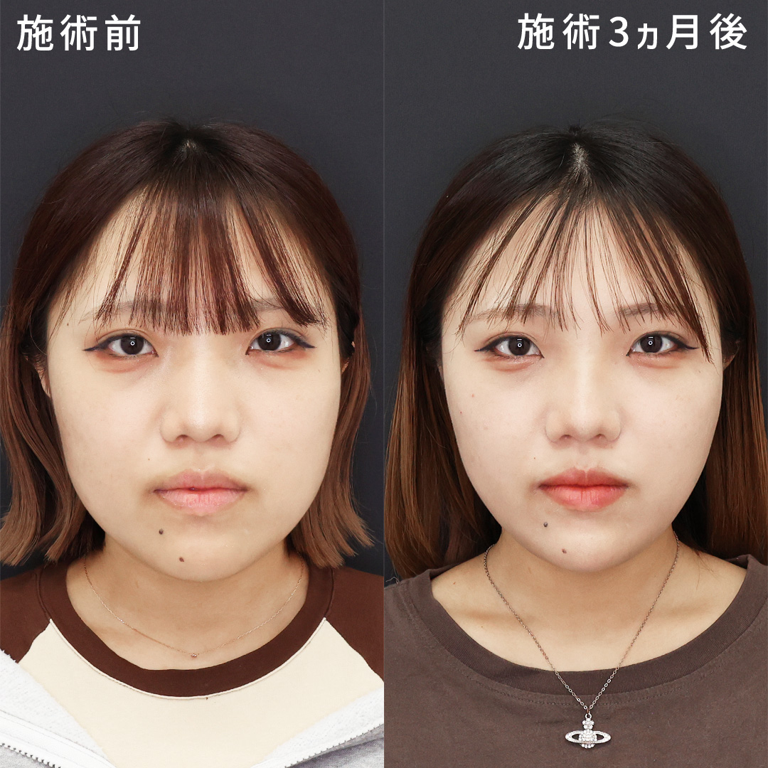 【丸顔卒業!】もたつきを無くし、憧れの卵型フェイスライン
