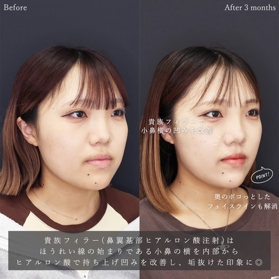 TAC式 ツヤ肌コラーゲンリフト®/顔の脂肪吸引/顎のヒアルロン酸注射の症例写真 施術前後