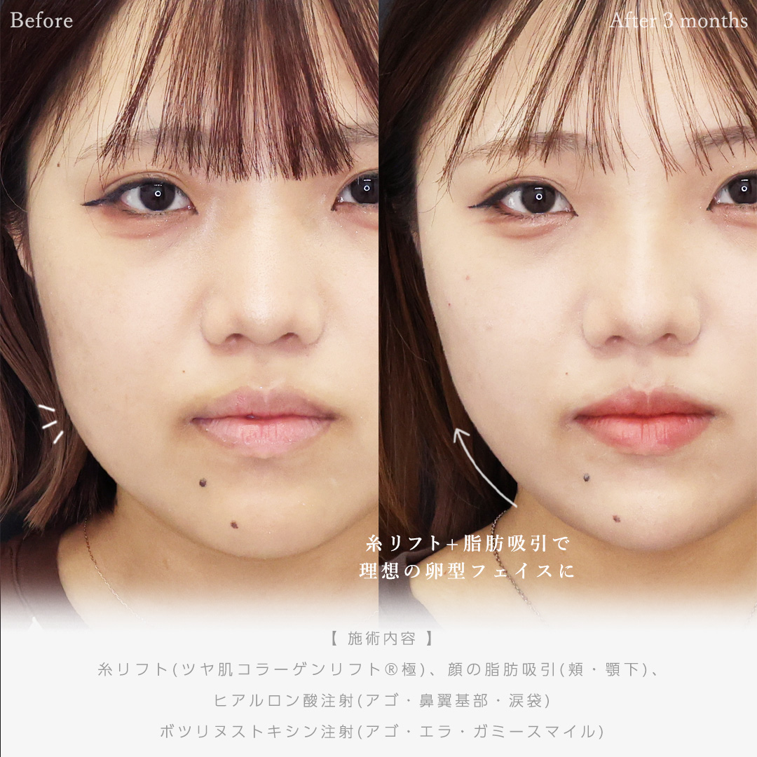 TAC式 ツヤ肌コラーゲンリフト®/顔の脂肪吸引/顎のヒアルロン酸注射の症例写真 施術前後