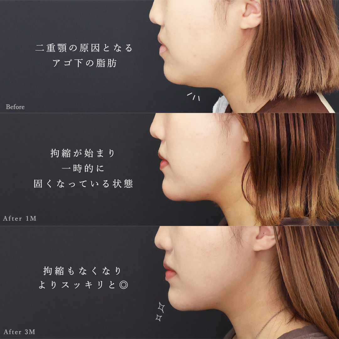 TAC式 ツヤ肌コラーゲンリフト®/顔の脂肪吸引/顎のヒアルロン酸注射の症例写真 施術前後