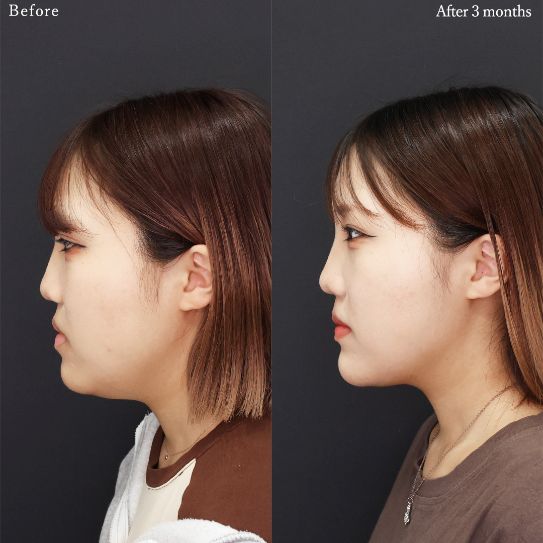TAC式 ツヤ肌コラーゲンリフト®/顔の脂肪吸引/顎のヒアルロン酸注射の症例写真 施術前後