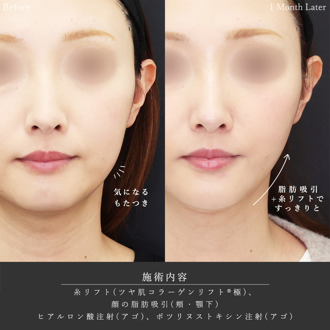 TAC式 ツヤ肌コラーゲンリフト®/顎下の脂肪吸引/顎のヒアルロン酸注射の症例写真 施術前後 
