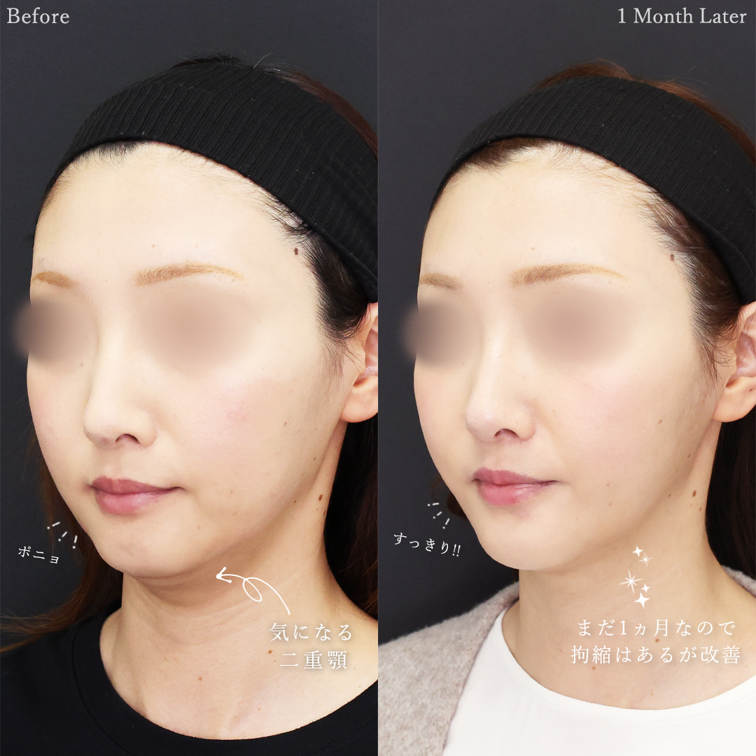 TAC式 ツヤ肌コラーゲンリフト®/顎下の脂肪吸引/顎のヒアルロン酸注射の症例写真 施術前後 