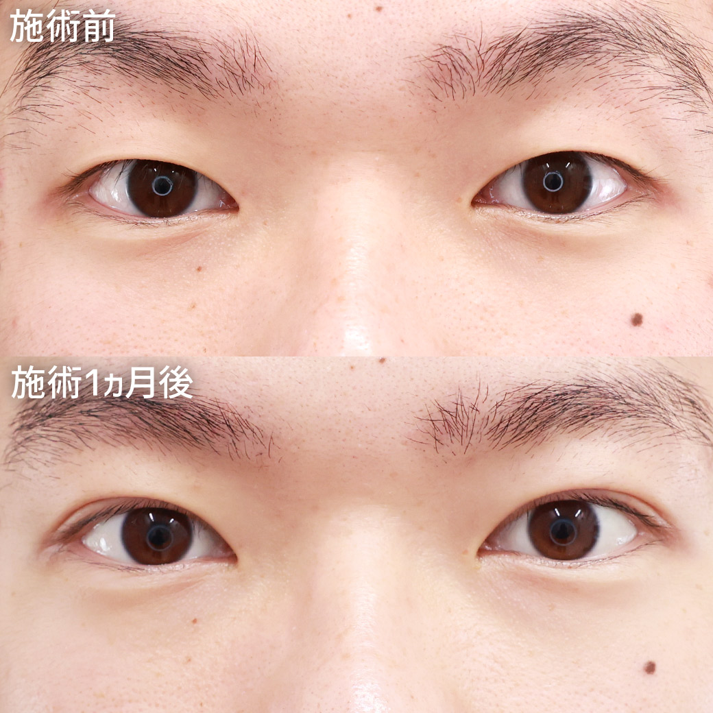 【クイックコスメリング】二重埋没法で目と眉が近づき、凛々しい印象に！