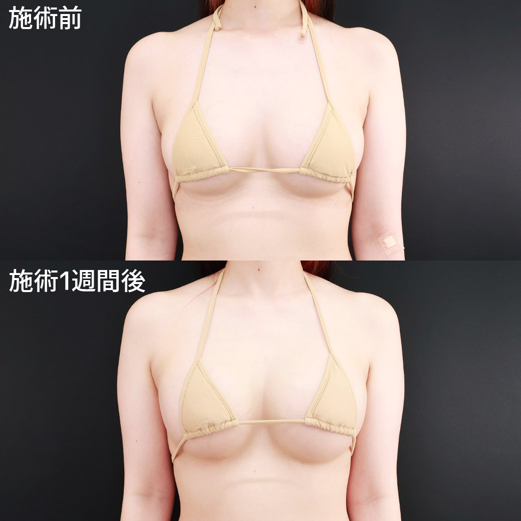 脂肪注入豊胸（コンデンスリッチ・ピュアグラフト・１day脂肪豊胸）の症例写真 施術前後 
