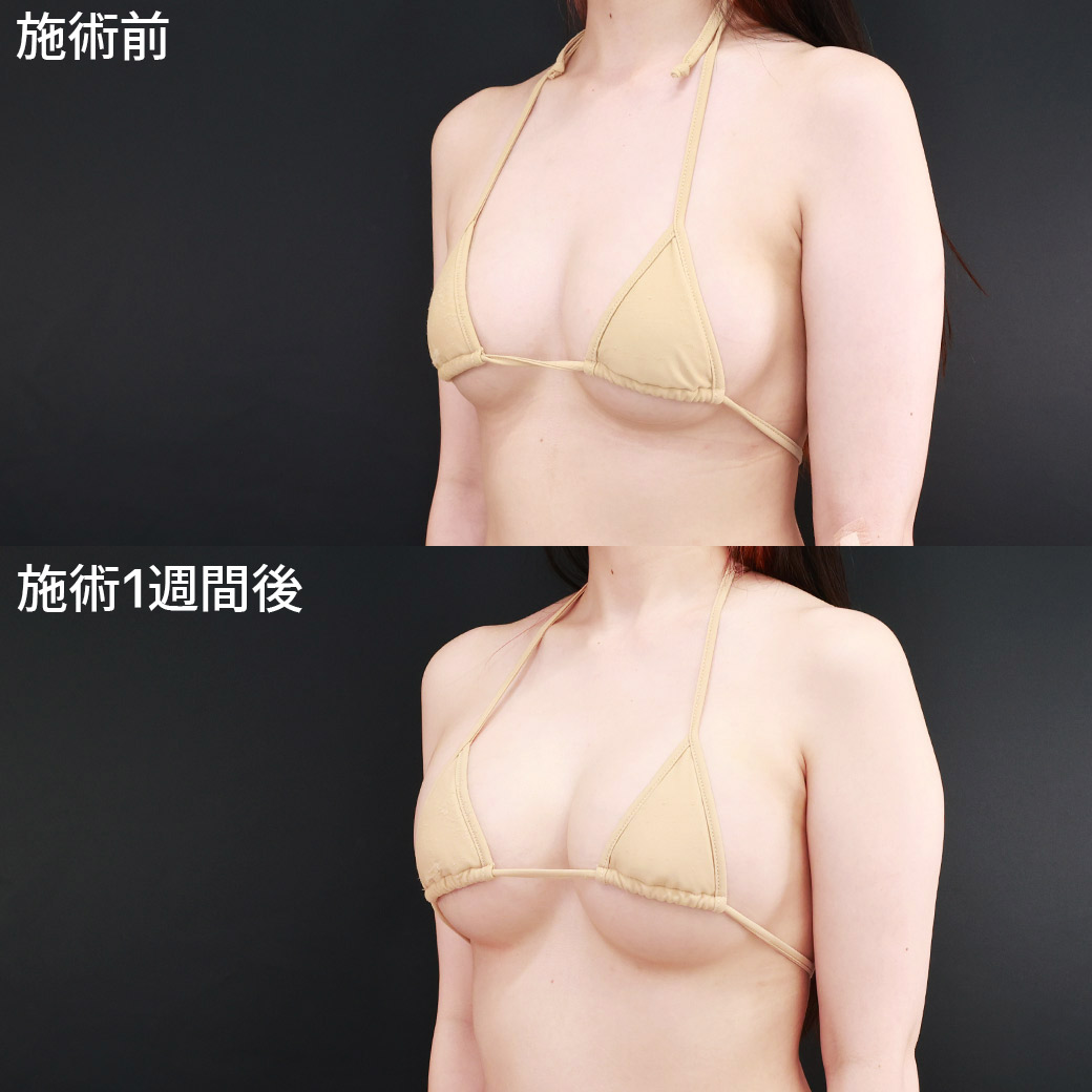 【コンデンスリッチ脂肪豊胸】体の動きに馴染む、天然級の大きく柔らかなバストを形成