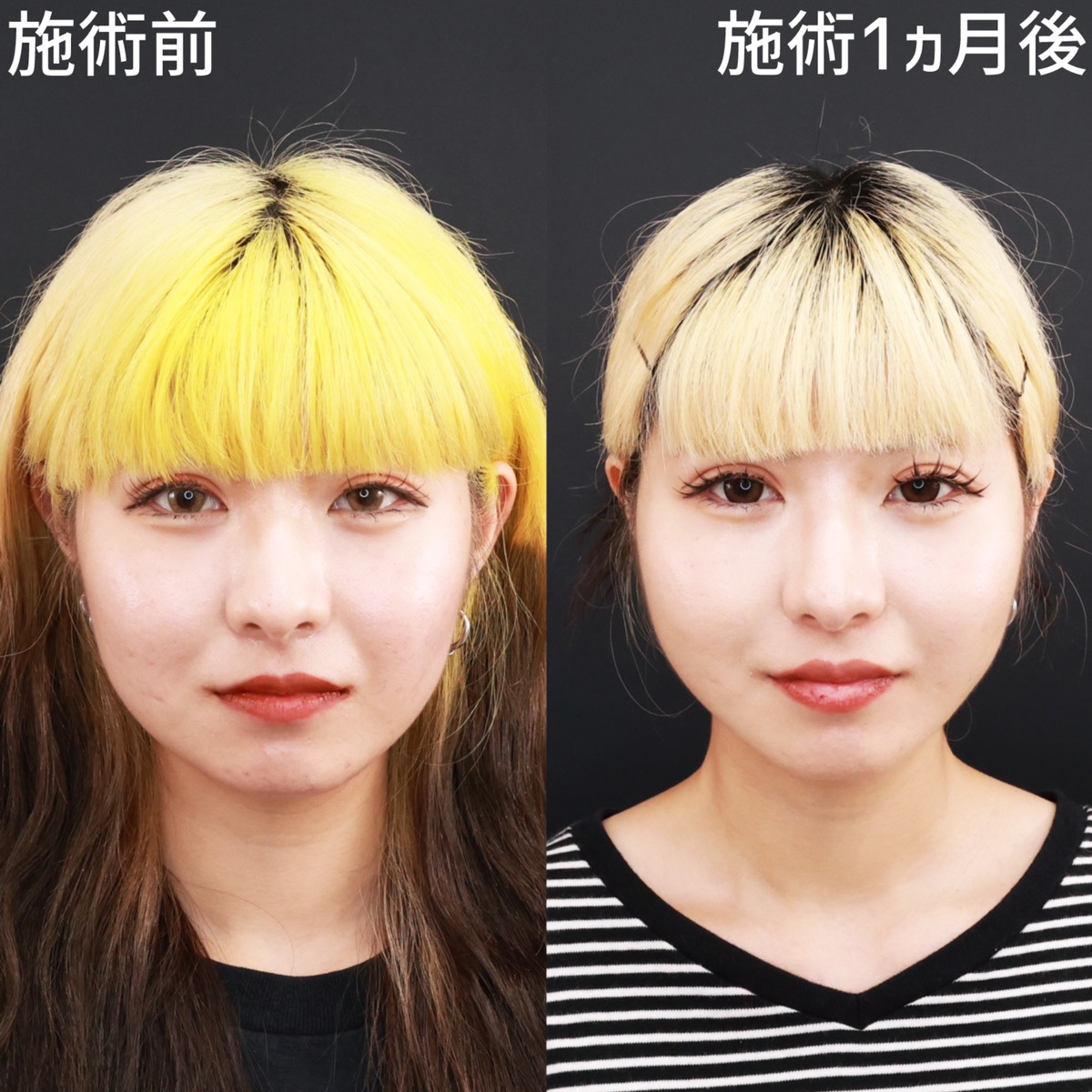 【糸リフト極×脂肪除去】お顔のボリュームを減らしスッキリ感を出す！