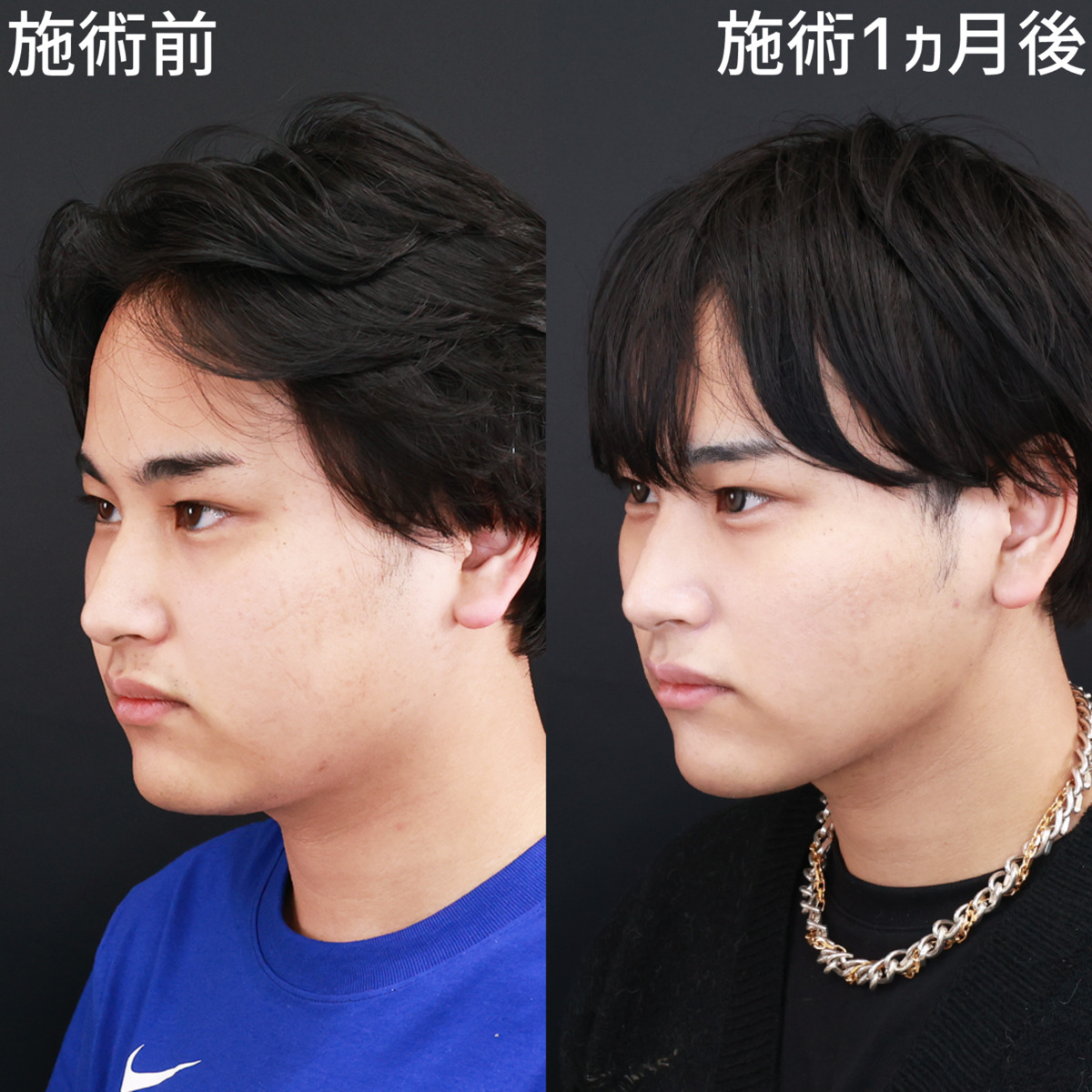 【糸リフト極×顎下脂肪吸引】クッキリと影が出るほど美しいフェイスラインに！