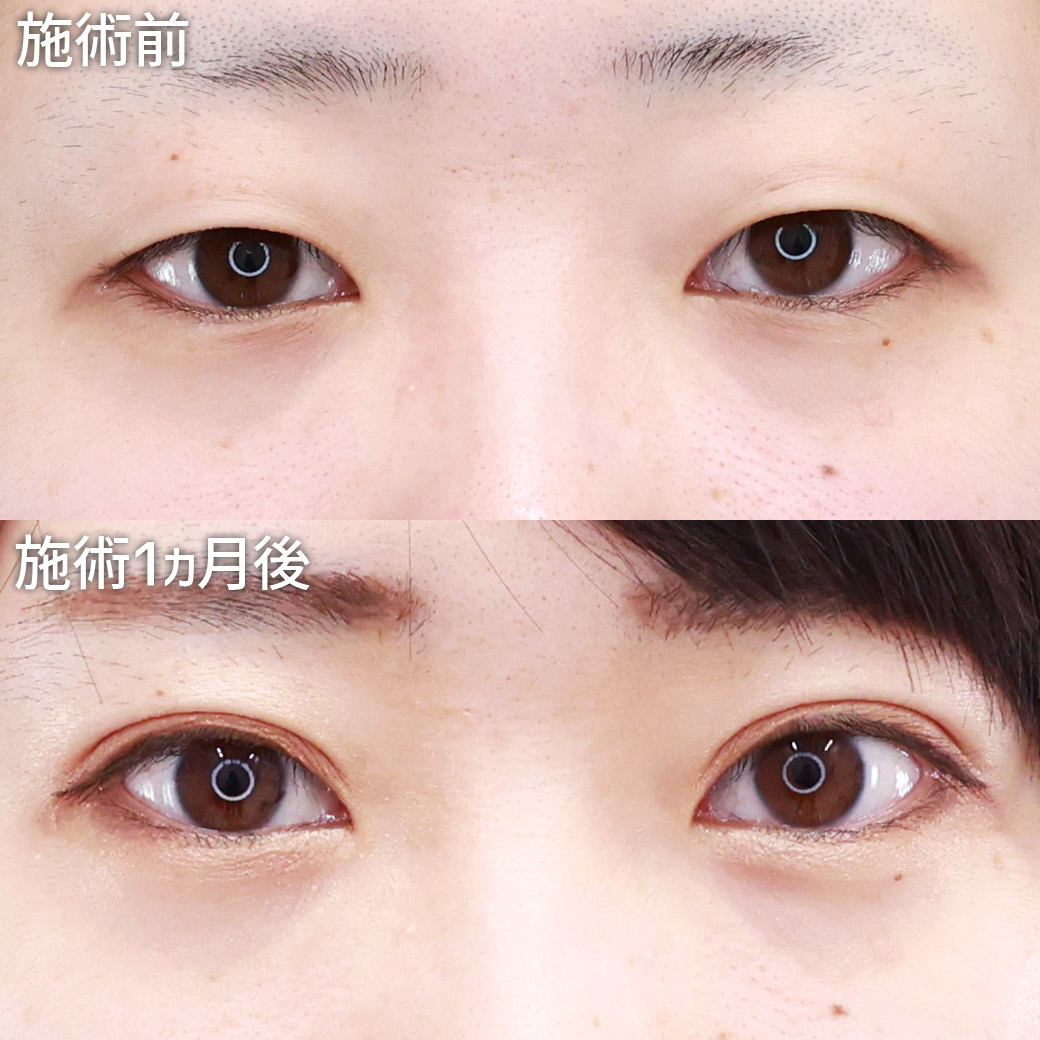 【クイックコスメリング】一重まぶたからスッキリとした幅狭めの平行二重に