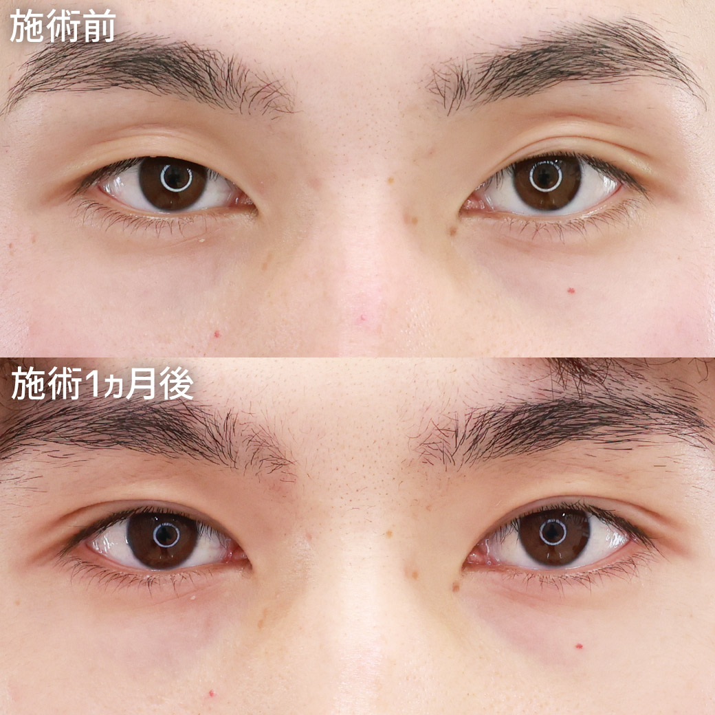 【メンズ美容】男性の垢抜けにもおすすめの二重埋没法