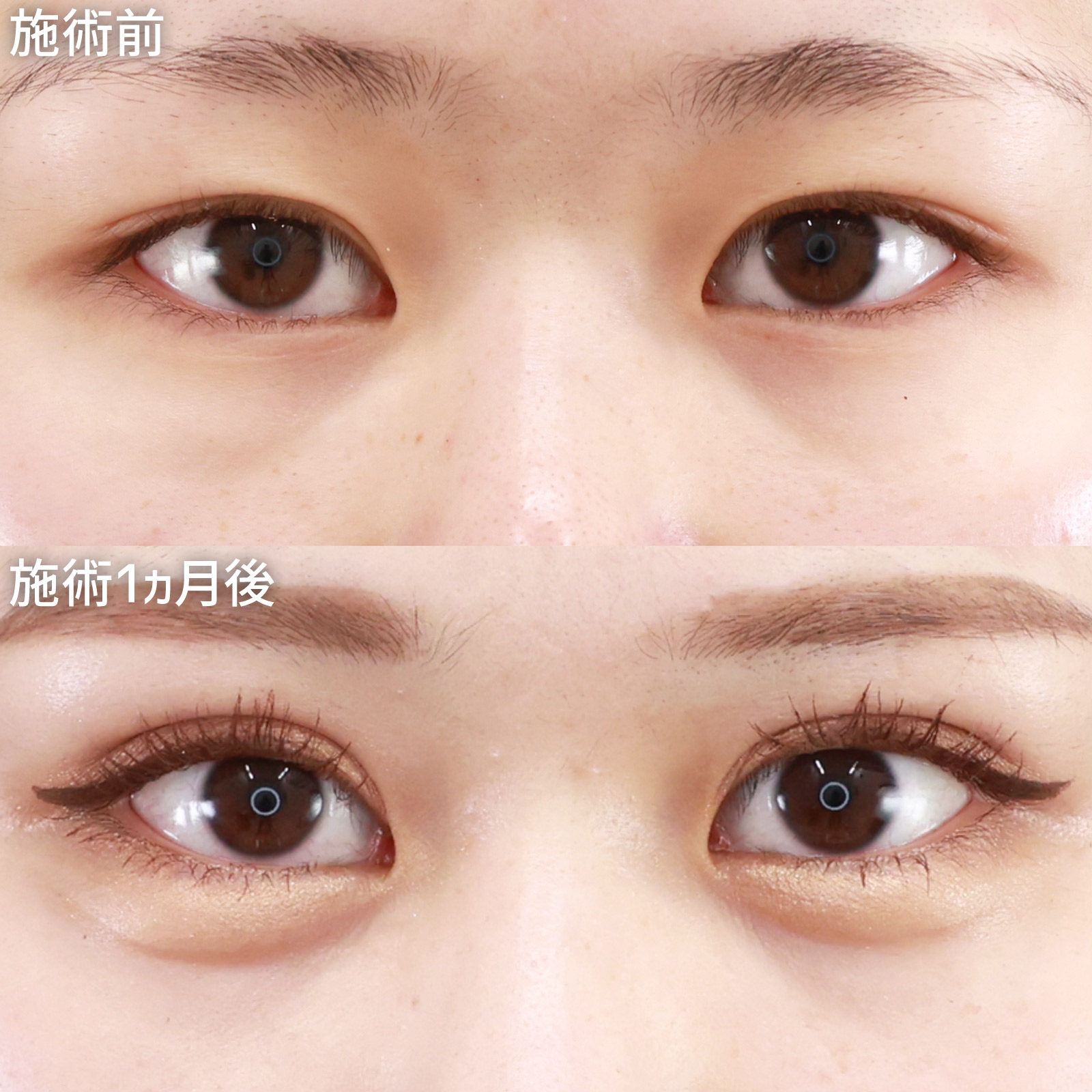 【クイックコスメリング】二重整形と涙袋のヒアルロン酸注射で一気に愛らしい目元に！