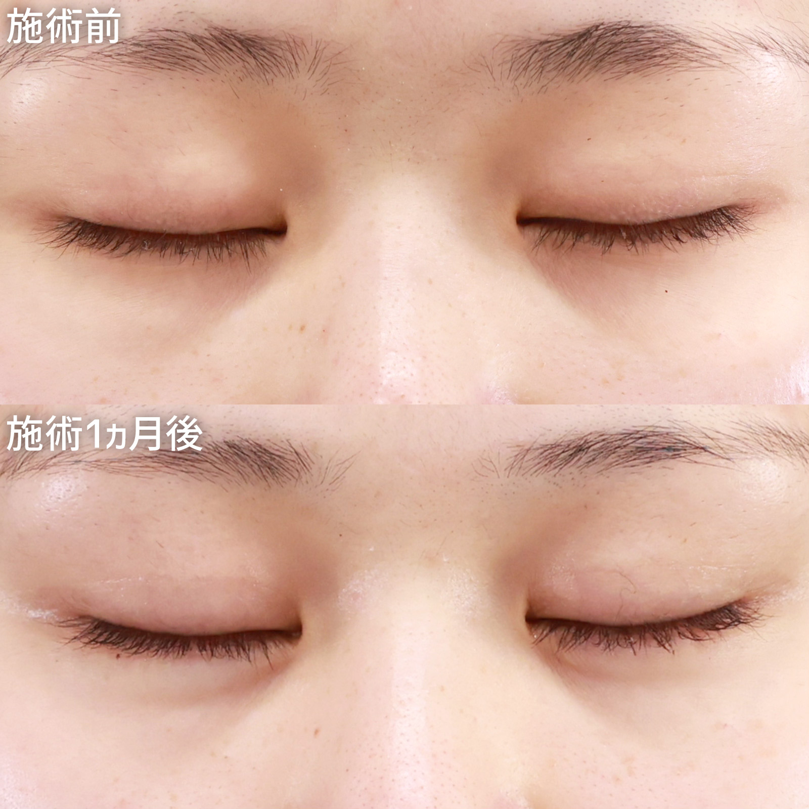 クイックコスメリング/涙袋形成(ヒアルロン酸注射)の症例写真 施術前後