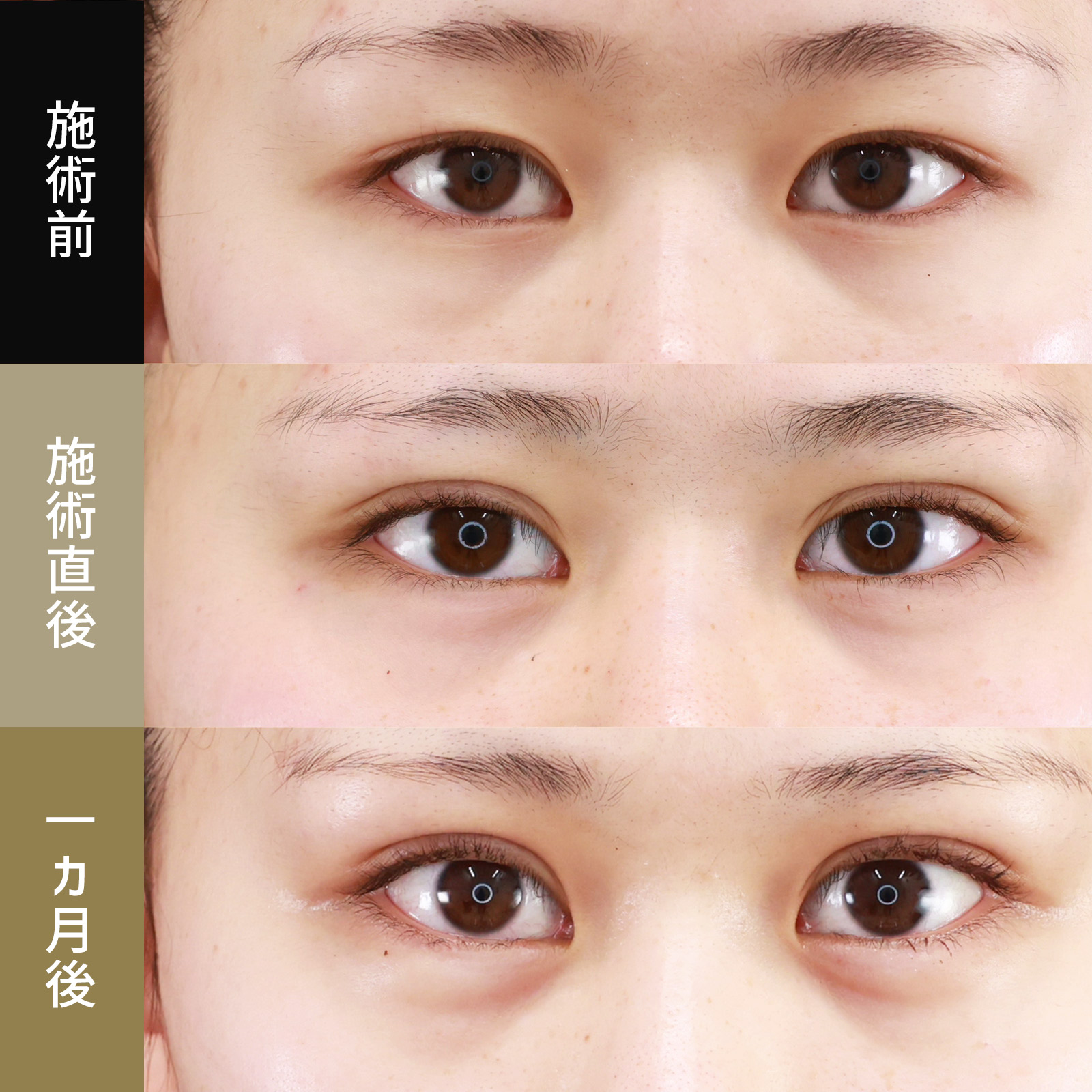 クイックコスメリング/涙袋形成(ヒアルロン酸注射)の症例写真 施術前後