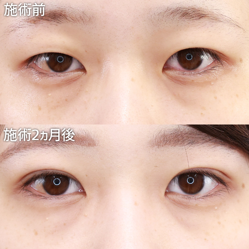 【バレにくい二重埋没法】短期間で確実に垢抜けるなら“クイックコスメリング”