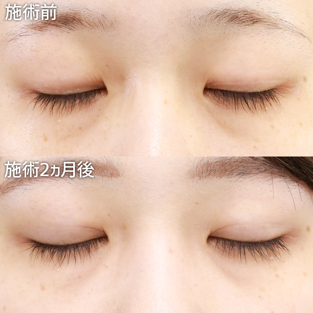 クイックコスメリングの症例写真 施術前後 