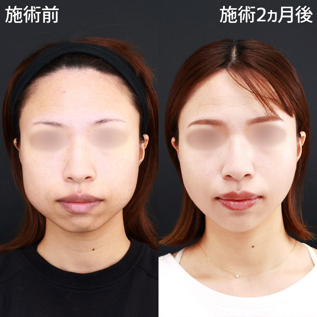 【パーフェクトフェイスライン】角張った輪郭を卵型に！別人級の小顔整形
