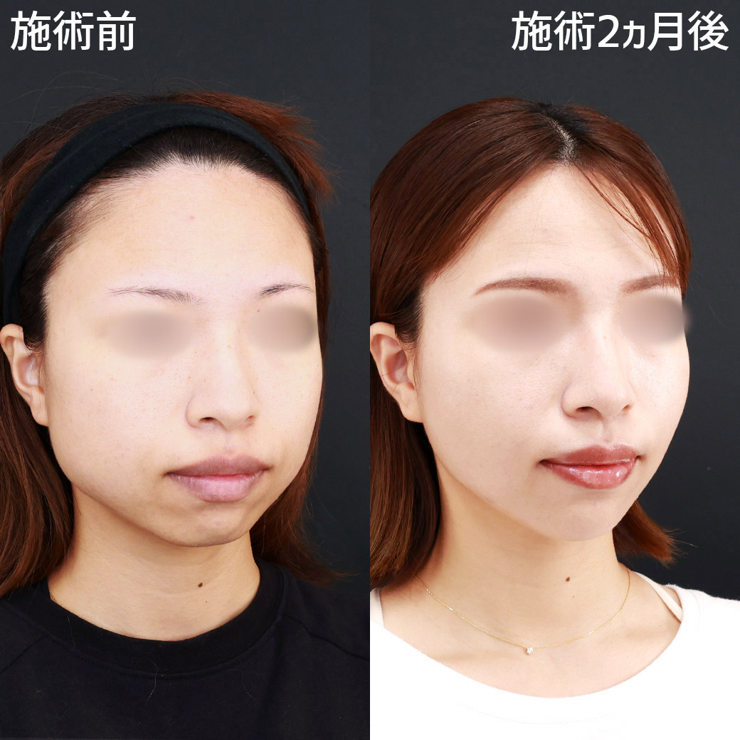小顔整形|パーフェクトフェイスライン/TAC式 ツヤ肌コラーゲンリフト®/バッカルファット除去の症例写真 施術前後
