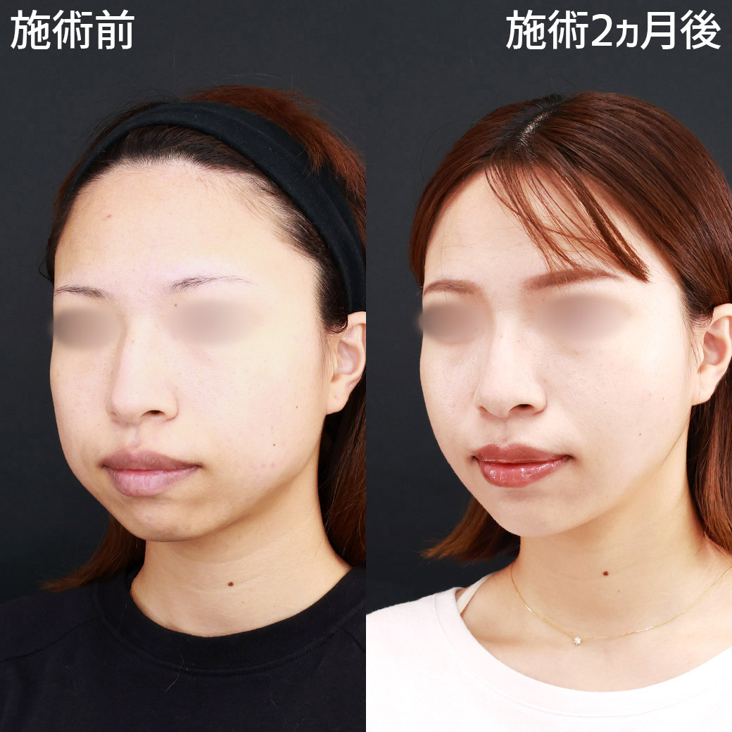 小顔整形|パーフェクトフェイスライン/TAC式 ツヤ肌コラーゲンリフト®/バッカルファット除去の症例写真 施術前後