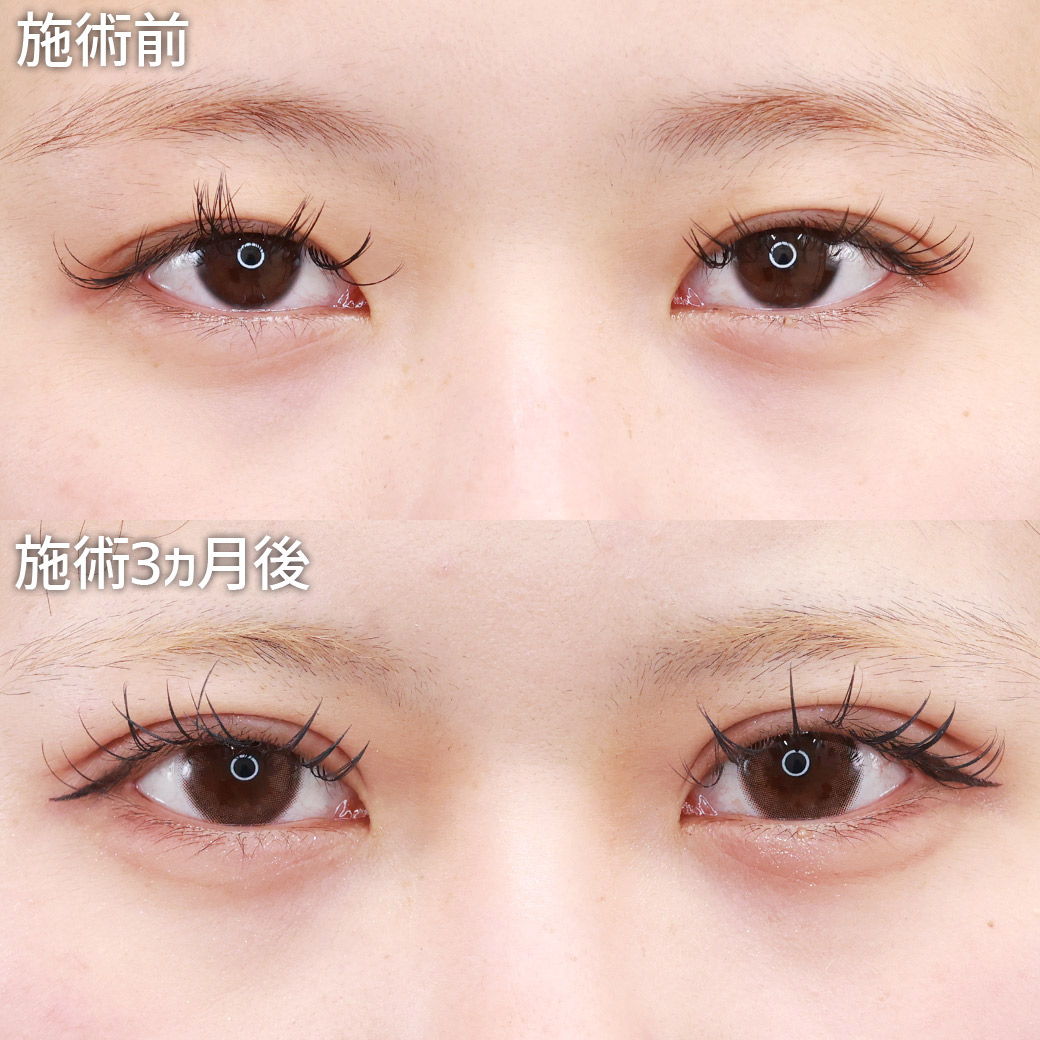 【二重埋没法】二重幅を広げて、より華やかで存在感のある目元に