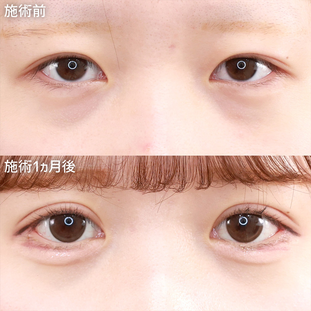 【二重全切開＆グラマラスライン】目の存在感を強く！カラコン映えする大きな目元に