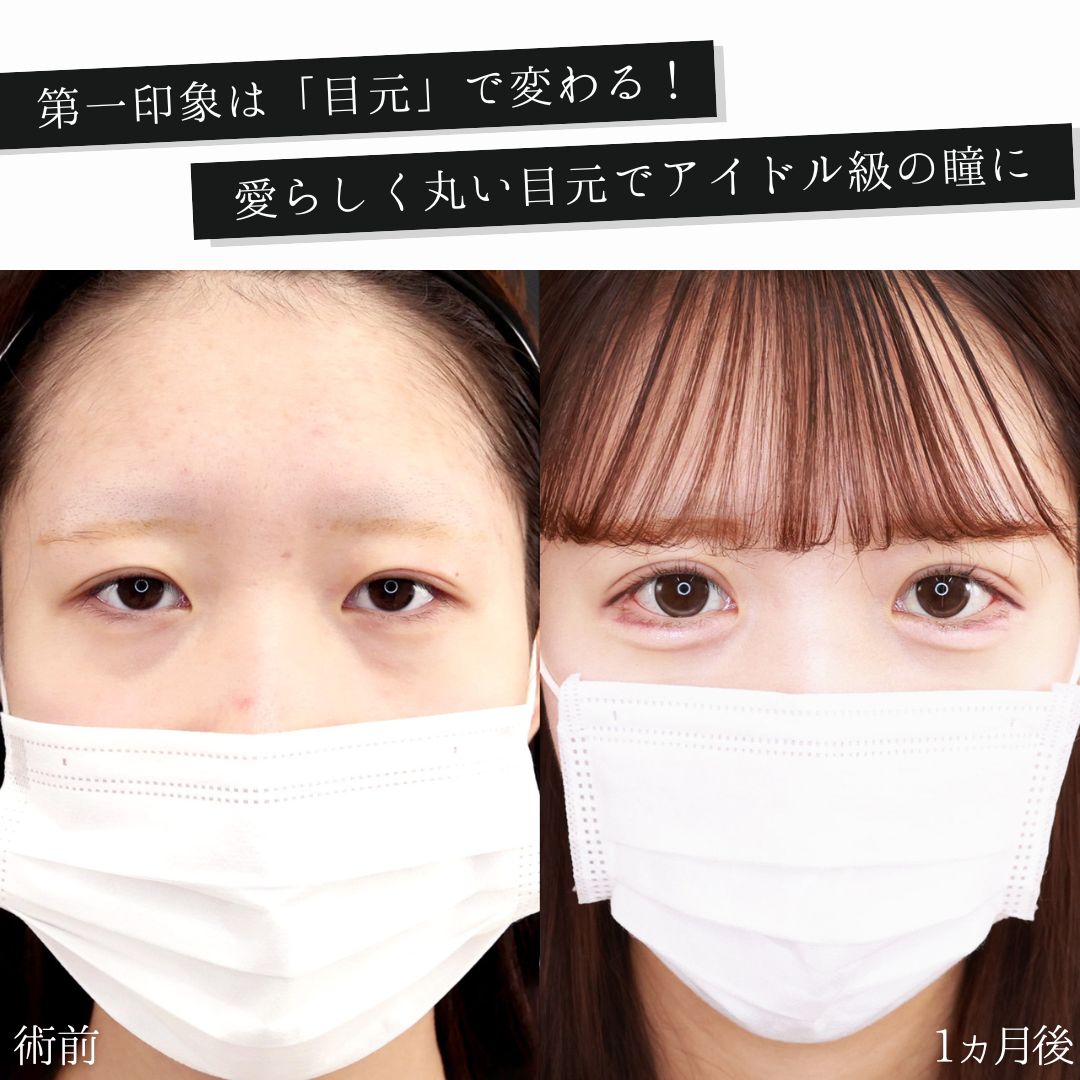 グラマラスライン（タレ目形成）/二重切開（全切開法）/目尻切開術の症例写真 施術前後 