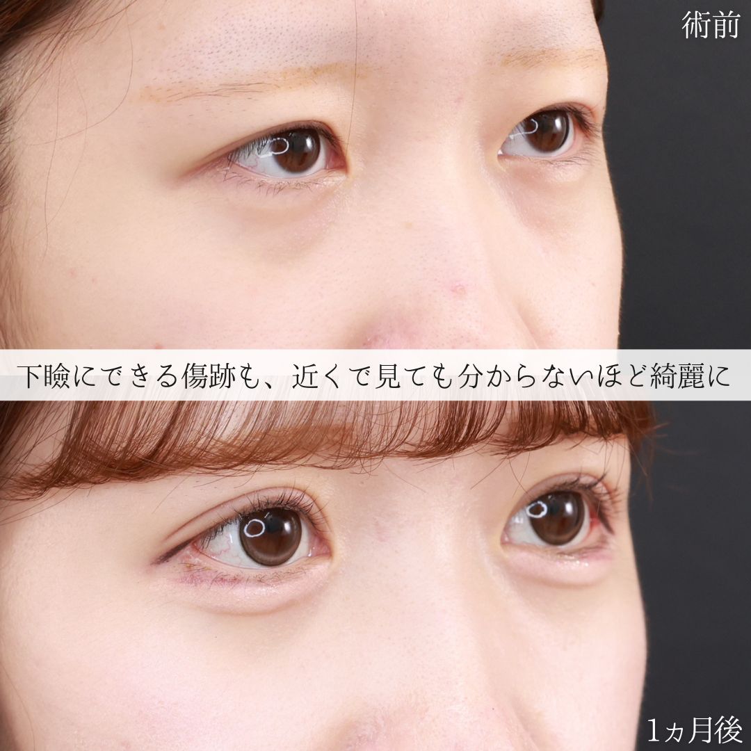 グラマラスライン（タレ目形成）/二重切開（全切開法）/目尻切開術の症例写真 施術前後 
