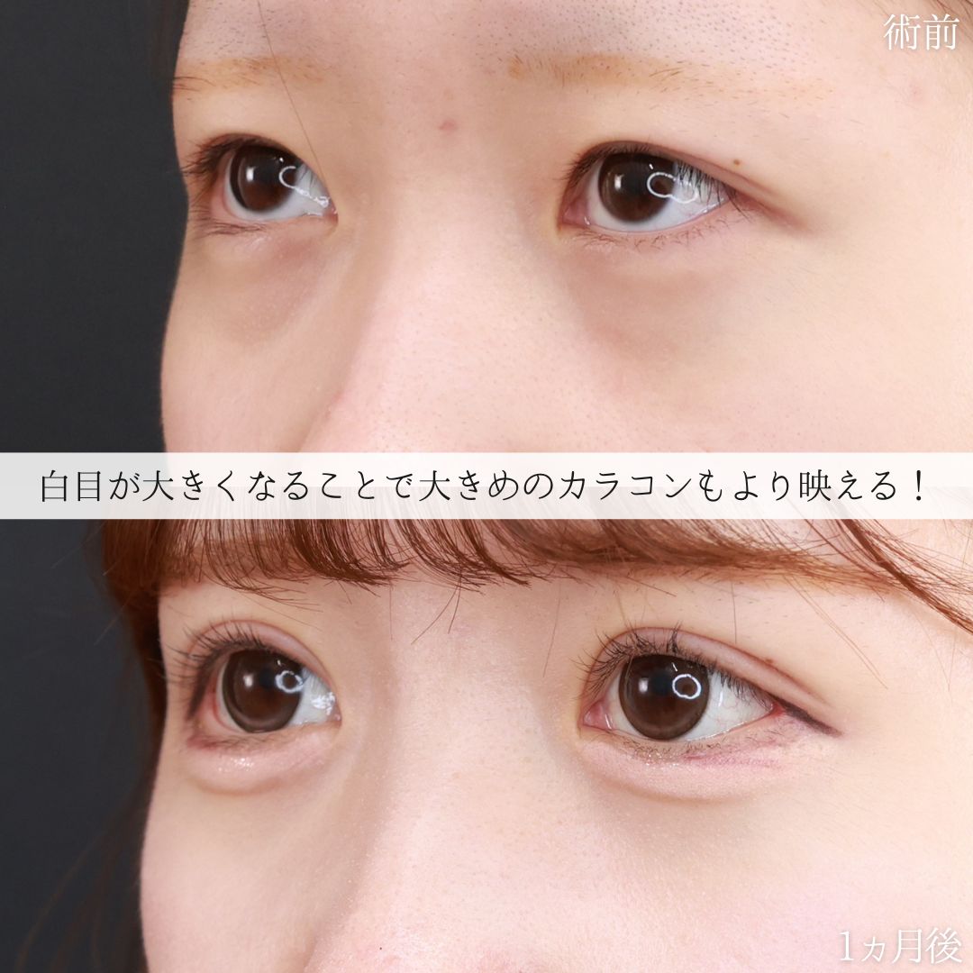 グラマラスライン（タレ目形成）/二重切開（全切開法）/目尻切開術の症例写真 施術前後 