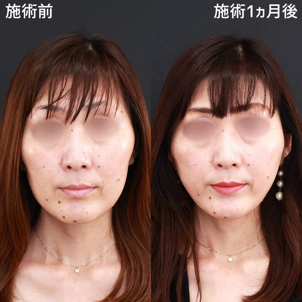 TAC式 ツヤ肌コラーゲンリフト®/ジョールファット除去/ヒアルロン酸注射:その他の症例写真 施術前後