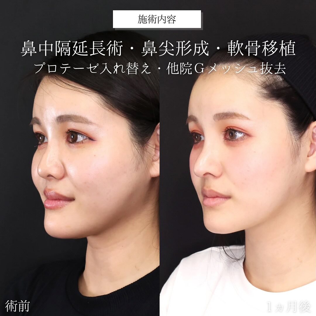 鼻中隔延長術/鼻尖形成・鼻尖縮小/鼻先軟骨移植の症例写真 施術前後 