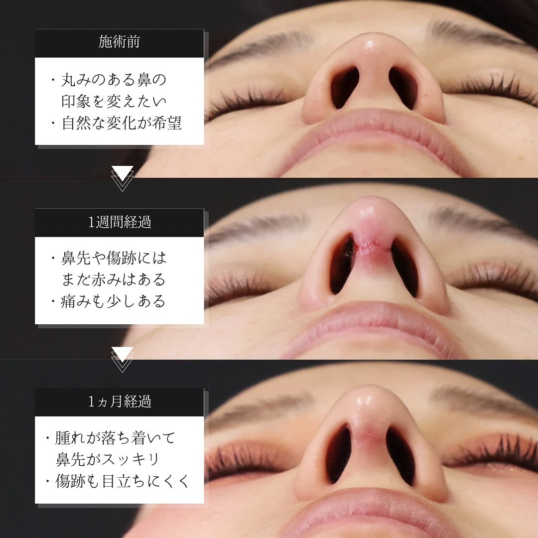 鼻中隔延長術/鼻尖形成・鼻尖縮小/鼻先軟骨移植の症例写真 施術前後 