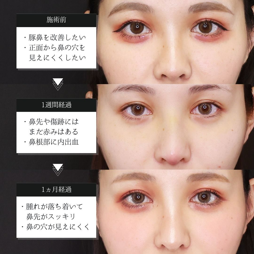 鼻中隔延長術/鼻尖形成・鼻尖縮小/鼻先軟骨移植の症例写真 施術前後 