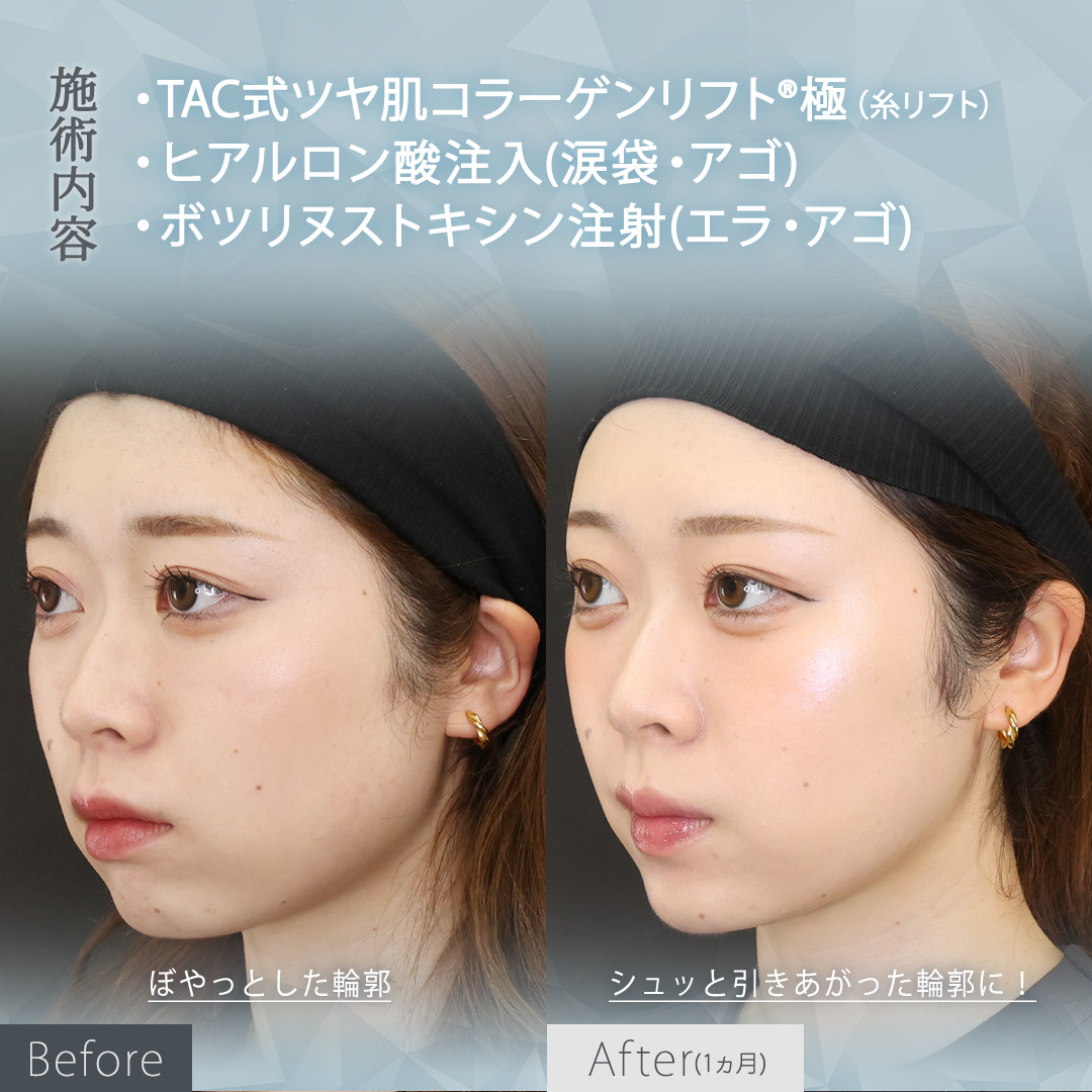 TAC式 ツヤ肌コラーゲンリフト®/涙袋形成(ヒアルロン酸注射)/顎のヒアルロン酸注射の症例写真 施術前後