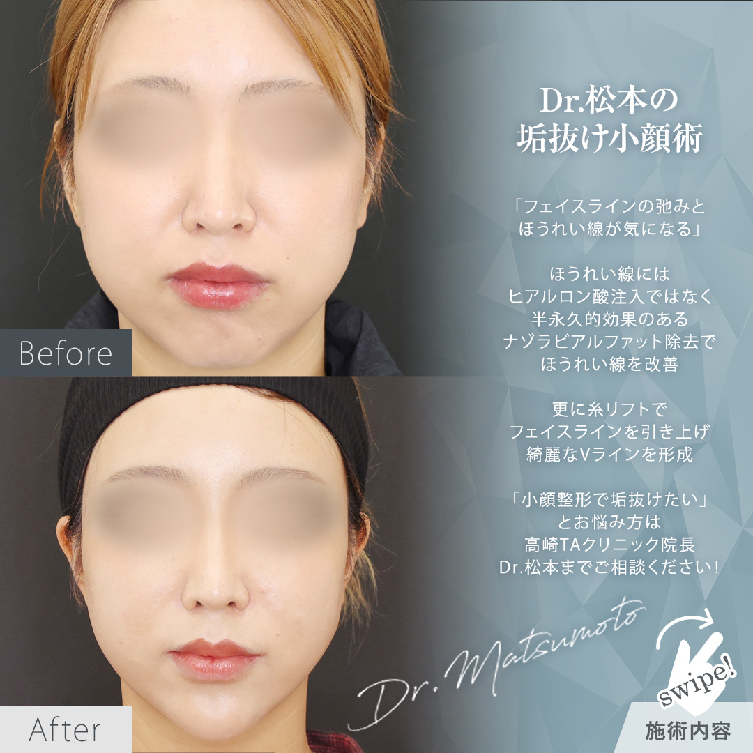 TAC式 ツヤ肌コラーゲンリフト®/ナゾラビアルファット除去/顎のヒアルロン酸注射の症例写真 施術前後 