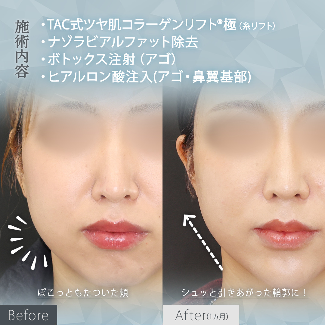 TAC式 ツヤ肌コラーゲンリフト®/ナゾラビアルファット除去/顎のヒアルロン酸注射の症例写真 施術前後 