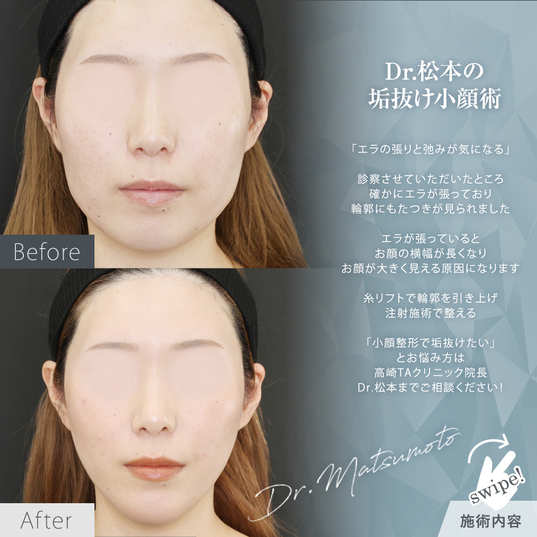 TAC式 ツヤ肌コラーゲンリフト®/顎のヒアルロン酸注射/エラボトックス注射の症例写真 施術前後 