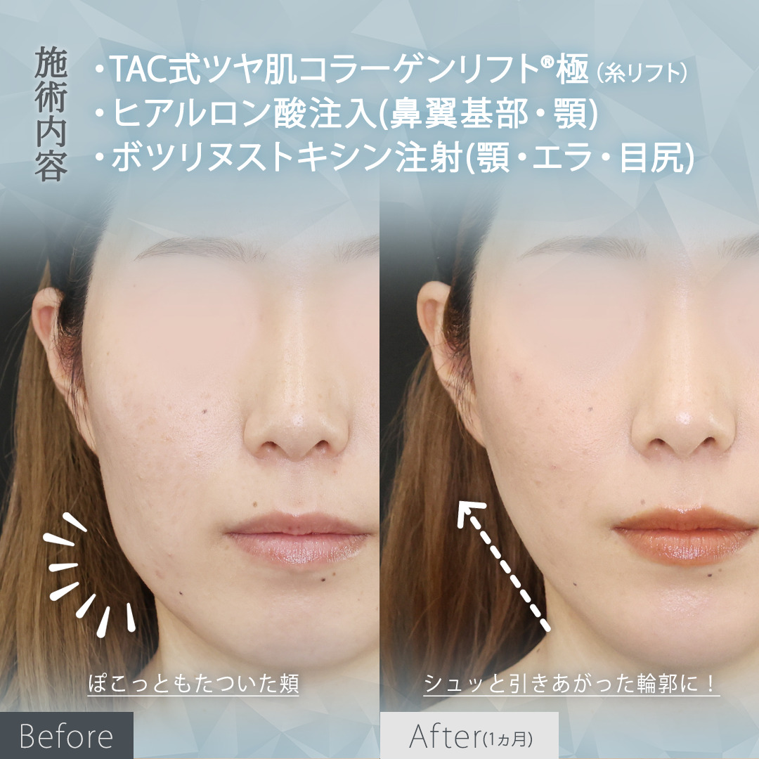 TAC式 ツヤ肌コラーゲンリフト®/顎のヒアルロン酸注射/エラボトックス注射の症例写真 施術前後 